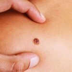 كل ما تريد معرفته عن عدوى فيروس الورم الحليمي البشري كل ما تريد معرفته عن عدوى فيروس الورم الحليمي البشري