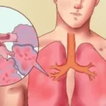 كل ما تحتاج لمعرفته عن الجلطة الرئوية: دليل شامل
