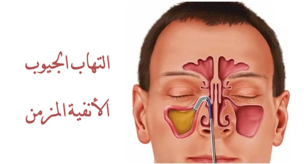 كل ما تحتاج لمعرفته عن التهاب الجيوب الأنفية للتخلص منه بسرعة
