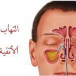 كل ما تحتاج لمعرفته عن التهاب الجيوب الأنفية للتخلص منه بسرعة