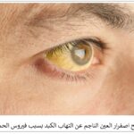 الحمى الصفراء: الأسباب والأعراض وطرق الوقاية الحمى الصفراء: الأسباب والأعراض وطرق الوقاية
