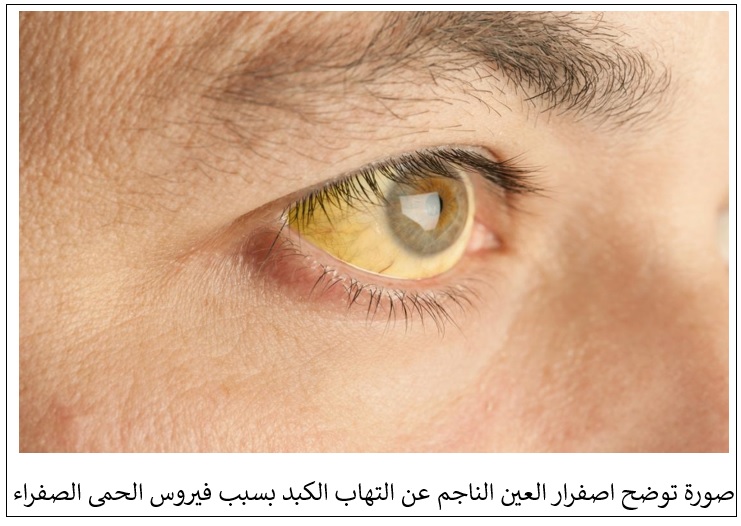 الحمى الصفراء: الأسباب والأعراض وطرق الوقاية الحمى الصفراء: الأسباب والأعراض وطرق الوقاية