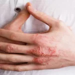 إكزيميا اليدين: فهم الأسباب والعلاج إكزيميا اليدين: فهم الأسباب والعلاج