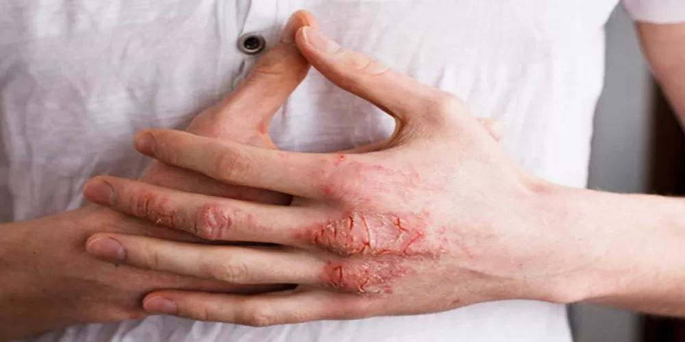 إكزيميا اليدين: فهم الأسباب والعلاج إكزيميا اليدين: فهم الأسباب والعلاج