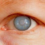 كل ما تحتاج معرفته عن جلوكوما: الأسباب والأعراض والعلاج كل ما تحتاج معرفته عن جلوكوما: الأسباب والأعراض والعلاج