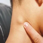 تورم الغدد اللمفاوية: الأسباب والعلاج والمضاعفات تورم الغدد اللمفاوية: الأسباب والعلاج والمضاعفات