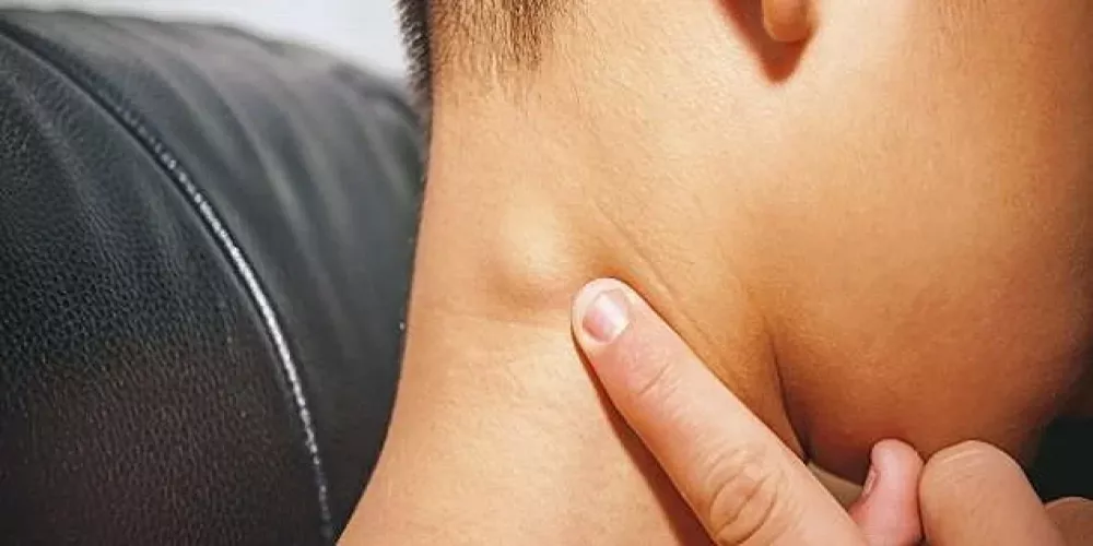 تورم الغدد اللمفاوية: الأسباب والعلاج والمضاعفات تورم الغدد اللمفاوية: الأسباب والعلاج والمضاعفات