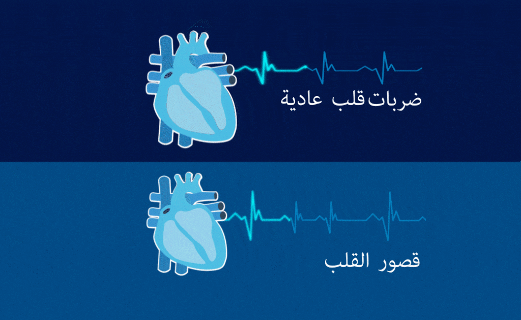 استكشاف أسرار قصور القلب: دليل شامل لأعراضها وعلاجها استكشاف أسرار قصور القلب: دليل شامل لأعراضها وعلاجها