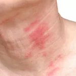 ما هو الحزام الناري؟ الأسباب والأعراض والعلاج ما هو الحزام الناري؟ الأسباب والأعراض والعلاج