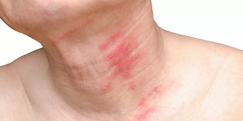 ما هو الحزام الناري؟ الأسباب والأعراض والعلاج