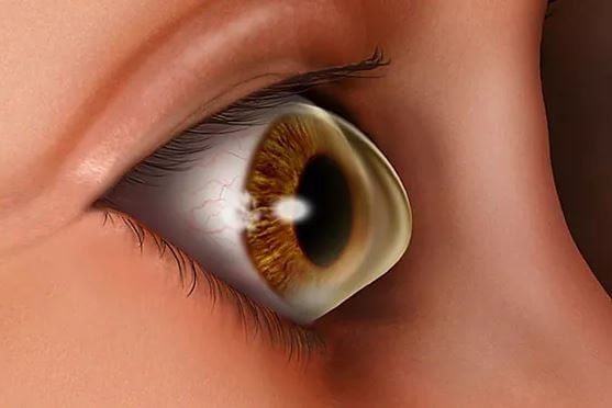 القرنية المخروطية: الأسباب والأعراض والعلاج القرنية المخروطية: الأسباب والأعراض والعلاج