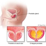 تضخم البروستاتا الحميد Benign prostatic hyperplasia: كل ما تحتاج لمعرفته