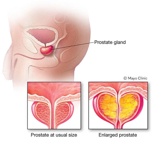 تضخم البروستاتا الحميد Benign prostatic hyperplasia: كل ما تحتاج لمعرفته