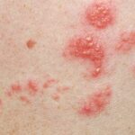 الحزام الناري: دراسة متعمقة عن الأسباب والأعراض والعلاجات الحزام الناري: دراسة متعمقة عن الأسباب والأعراض والعلاجات