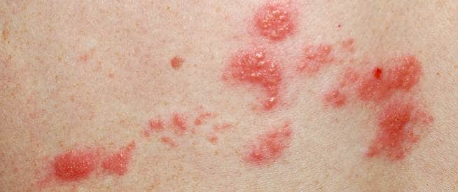 الحزام الناري: دراسة متعمقة عن الأسباب والأعراض والعلاجات الحزام الناري: دراسة متعمقة عن الأسباب والأعراض والعلاجات