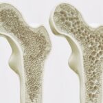 كل ما تحتاج معرفته عن هشاشة العظام