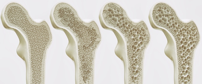 كل ما تحتاج معرفته عن هشاشة العظام كل ما تحتاج معرفته عن هشاشة العظام