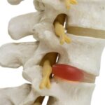 كل ما تحتاج لمعرفته عن الانزلاق الغضروفي: دليل شامل كل ما تحتاج لمعرفته عن الانزلاق الغضروفي: دليل شامل