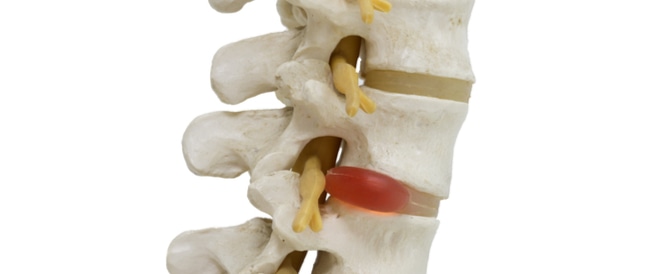 كل ما تحتاج لمعرفته عن الانزلاق الغضروفي: دليل شامل كل ما تحتاج لمعرفته عن الانزلاق الغضروفي: دليل شامل
