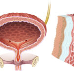 أسباب وعلاجات فعالة لإلتهاب المثانة: دليل شامل أسباب وعلاجات فعالة لإلتهاب المثانة: دليل شامل