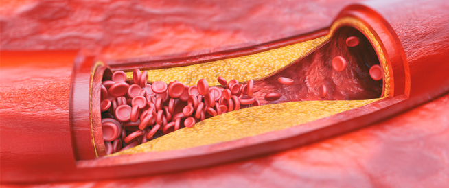 اسباب وعلاج تصلب الشرايين: دليلك الشامل للوقاية والعلاج