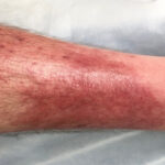 التهاب النسيج الخلوي: فهم الأسباب والعلاج التهاب النسيج الخلوي: فهم الأسباب والعلاج