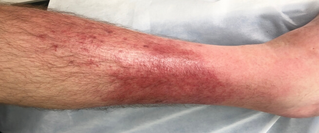 التهاب النسيج الخلوي: فهم الأسباب والعلاج التهاب النسيج الخلوي: فهم الأسباب والعلاج