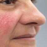 الوردية: فهم الأسباب والعلاج الوردية: فهم الأسباب والعلاج