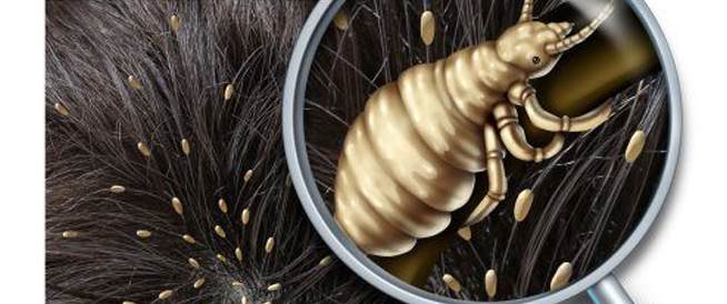 أفضل طرق علاج القمل للاطفال بشكل فعّال وسريع أفضل طرق علاج القمل للاطفال بشكل فعّال وسريع