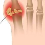 دليلك الشامل لفهم النقرس وأسبابه وطرق علاجه دليلك الشامل لفهم النقرس وأسبابه وطرق علاجه