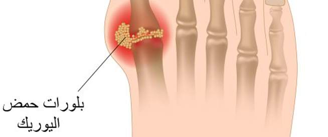 دليلك الشامل لفهم النقرس وأسبابه وطرق علاجه