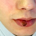 الزهري: فهم الأسباب والعلاج الزهري: فهم الأسباب والعلاج