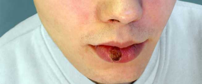 الزهري: فهم الأسباب والعلاج الزهري: فهم الأسباب والعلاج