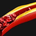 ما يجب معرفته عن الكوليسترول المرتفع وأسبابه ما يجب معرفته عن الكوليسترول المرتفع وأسبابه