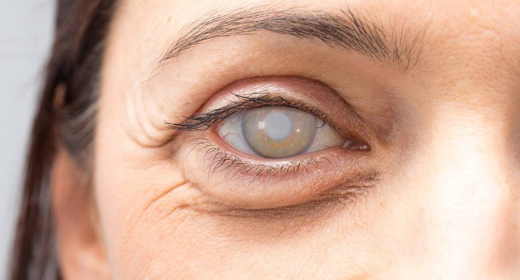 كل شيء عن الماء الأبيض: الأسباب، الأعراض، والعلاج كل شيء عن الماء الأبيض: الأسباب، الأعراض، والعلاج