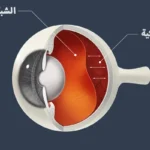 ماهو انفصال الشبكية وأسبابه وأعراضه وعلاجه ماهو انفصال الشبكية وأسبابه وأعراضه وعلاجه