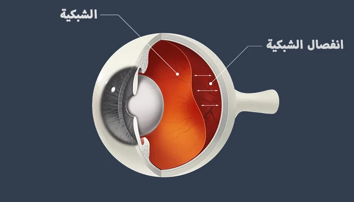 ماهو انفصال الشبكية وأسبابه وأعراضه وعلاجه ماهو انفصال الشبكية وأسبابه وأعراضه وعلاجه