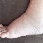 داء الفيل: الأسباب والعلاج والتأثيرات داء الفيل: الأسباب والعلاج والتأثيرات