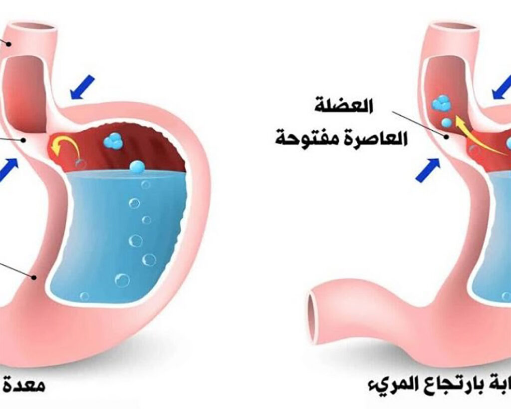 أسباب وعلاجات ارتجاع المريء: دليلك الشامل