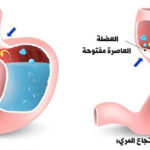 أسباب وعلاجات ارتجاع المريء: دليلك الشامل أسباب وعلاجات ارتجاع المريء: دليلك الشامل