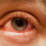 كل ما تحتاج معرفته عن التهاب الملتحمة كل ما تحتاج معرفته عن التهاب الملتحمة