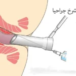 كل ما تحتاج معرفته عن الشرخ: الأسباب والعلاج