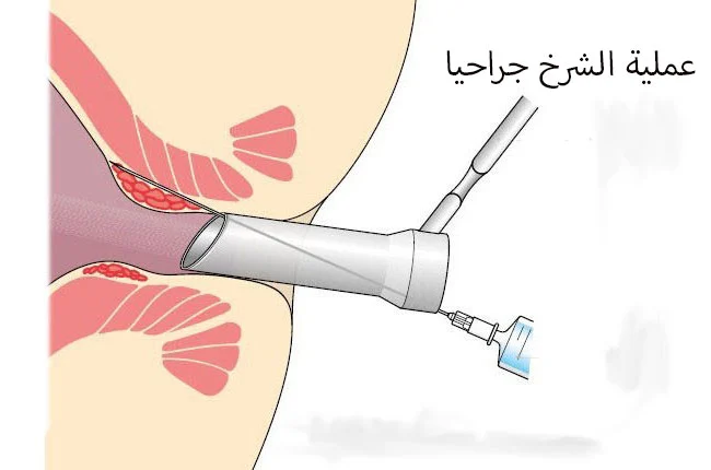 كل ما تحتاج معرفته عن الشرخ: الأسباب والعلاج كل ما تحتاج معرفته عن الشرخ: الأسباب والعلاج