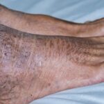 السُّماك: الأسباب والعلاج والمضاعفات السُّماك: الأسباب والعلاج والمضاعفات