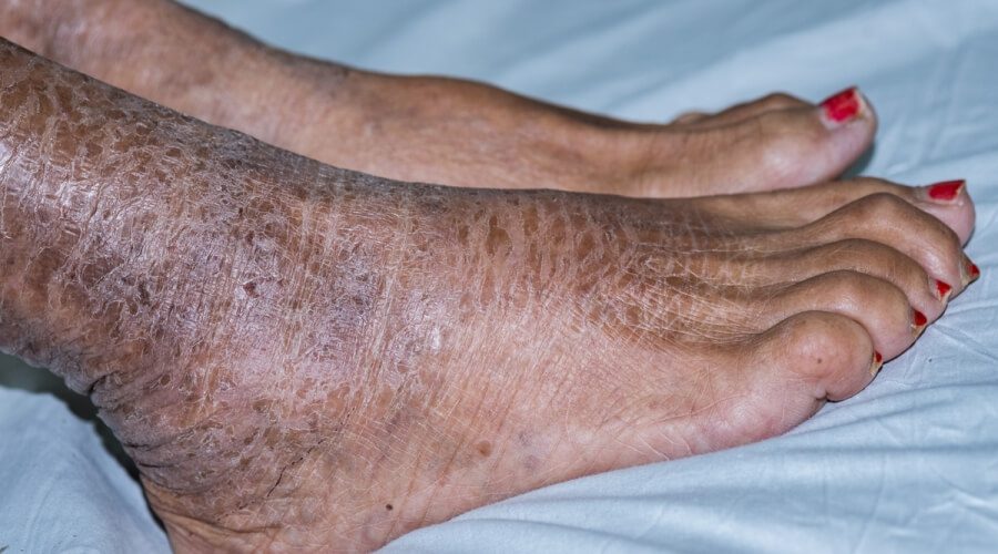 السُّماك: الأسباب والعلاج والمضاعفات السُّماك: الأسباب والعلاج والمضاعفات