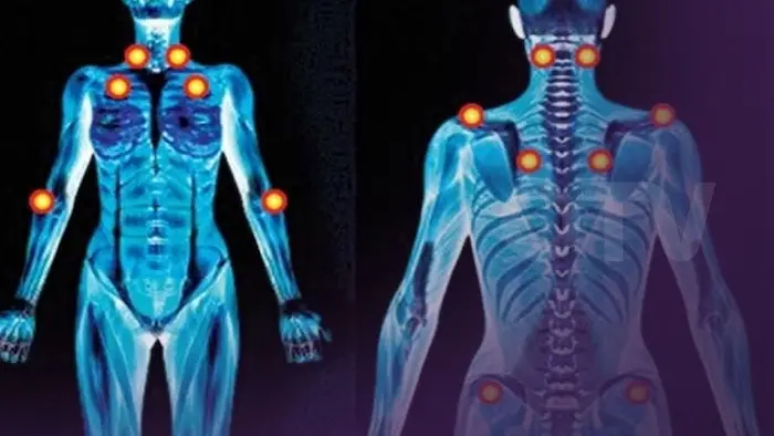 كل ما تحتاج لمعرفته عن الفايبروميالجيا: التشخيص والعلاج كل ما تحتاج لمعرفته عن الفايبروميالجيا: التشخيص والعلاج